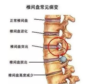 椎间盘常见病变