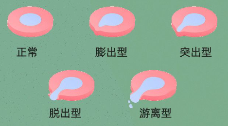 椎间盘突出四阶段