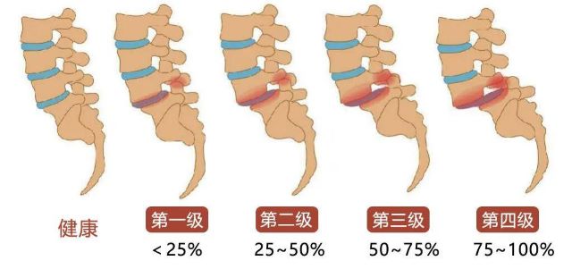 腰椎滑脱分级