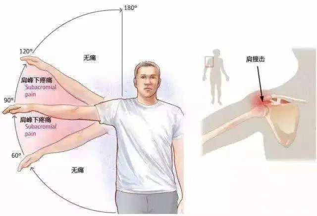 肩关节活动受限