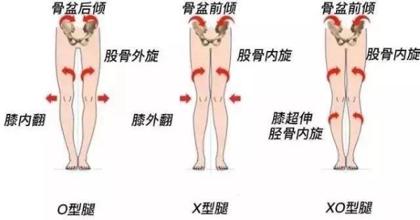 腿型问题