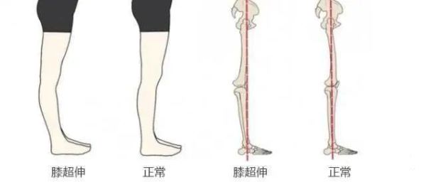 膝超伸对比图