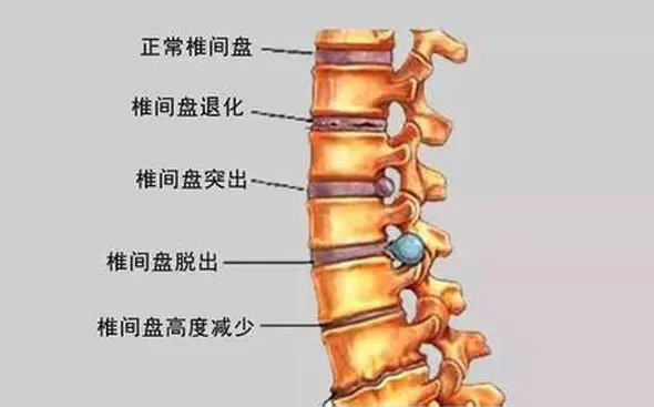 椎间盘病变
