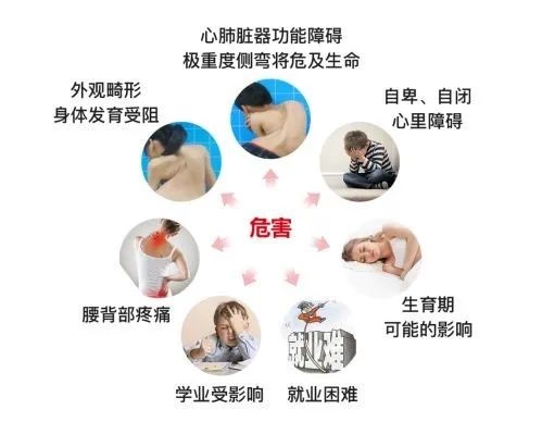 脊柱侧弯危害