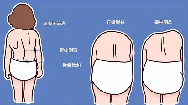 脊柱侧弯对比图