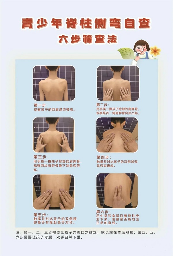 脊柱侧弯六步筛查法