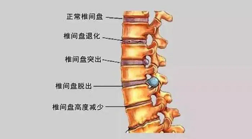 椎间盘病变