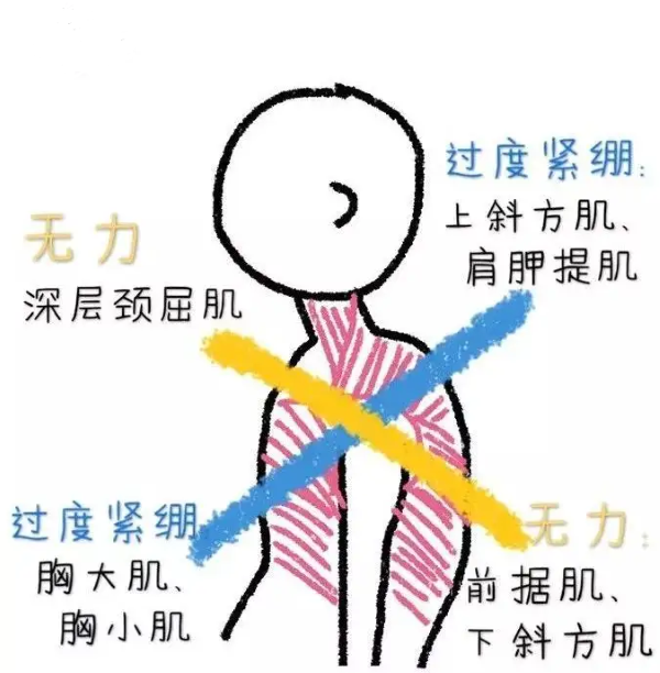 上交叉综合征