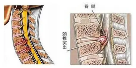 颈椎突出
