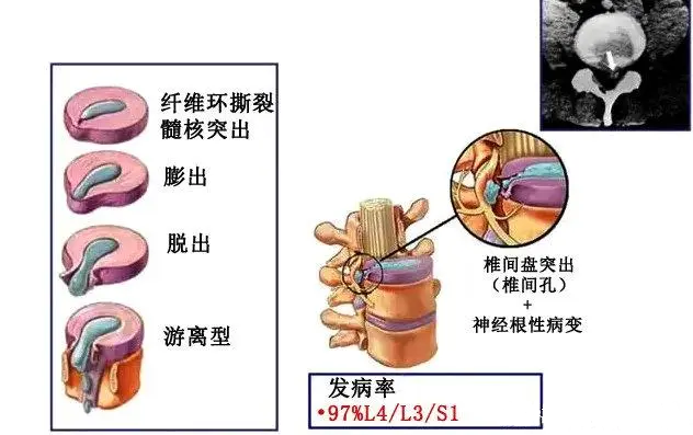 椎间盘突出