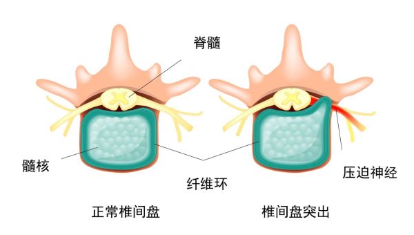 椎间盘突出示意图