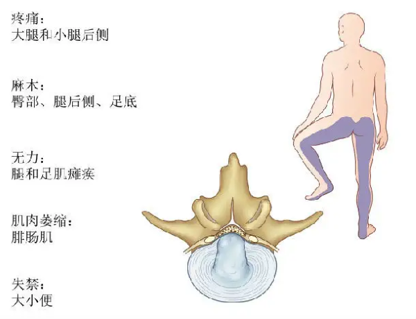 腰椎间盘突出症状