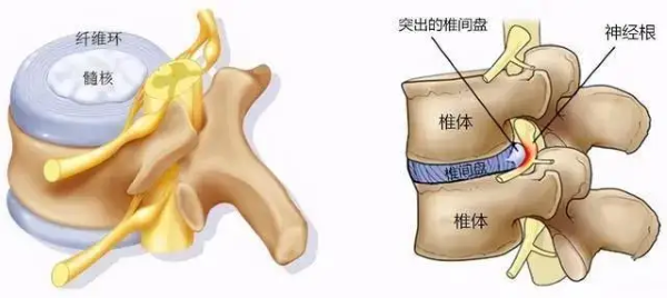 腰椎间盘突出