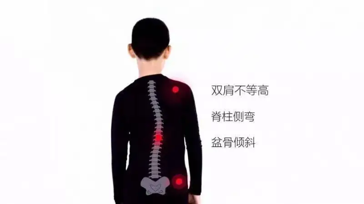 脊柱侧弯
