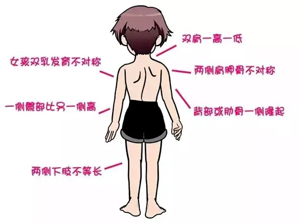 脊柱侧弯症状