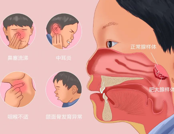 腺样体肥大症状