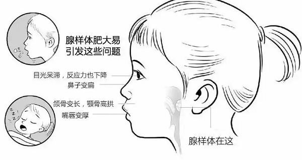 腺样体面容