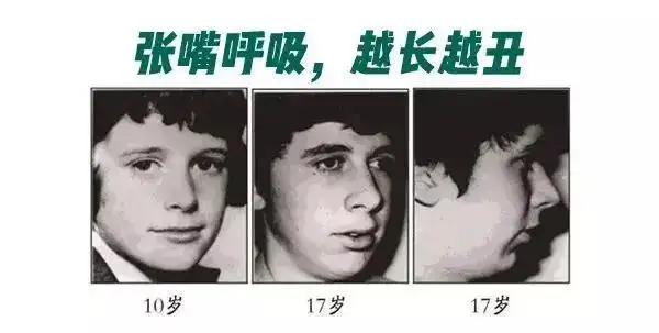 腺样体面容