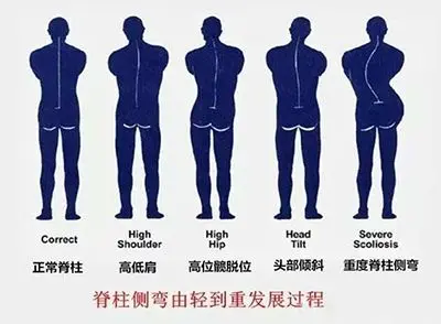 脊柱侧弯由轻到重发展过程