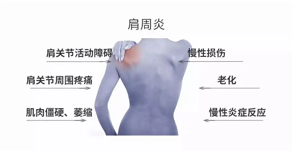 肩周炎症状
