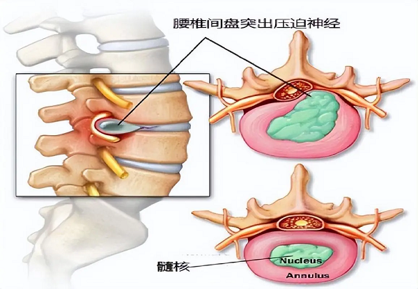 腰椎间盘突出