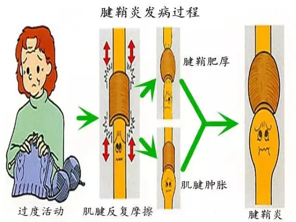 腱鞘炎发病过程