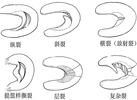 半月板损伤