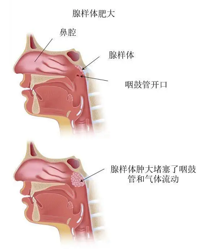 腺样体肥大