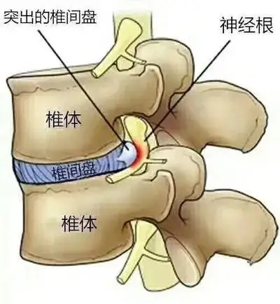 腰椎间盘突出