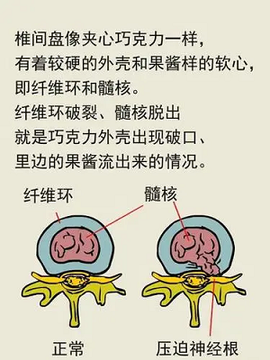 腰椎间盘突出