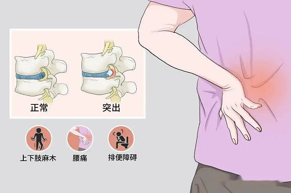 腰椎间盘突出症状