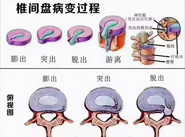 椎间盘病变过程