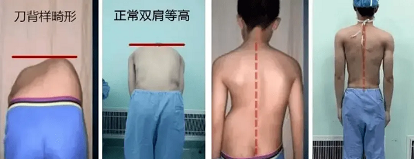 居家弯腰实验观察背部异常