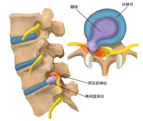 椎间盘突出