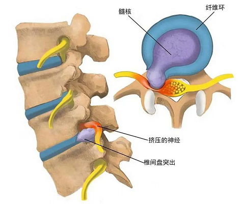 椎间盘突出示意图