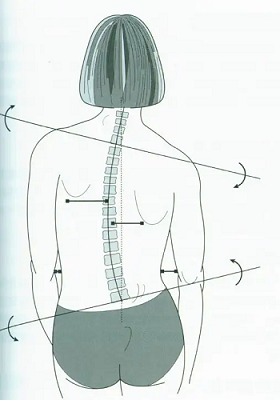 脊柱偏离中线