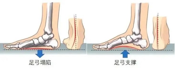 足弓塌陷和足弓支撑对比图