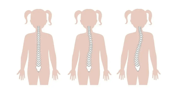 脊柱侧弯对比图
