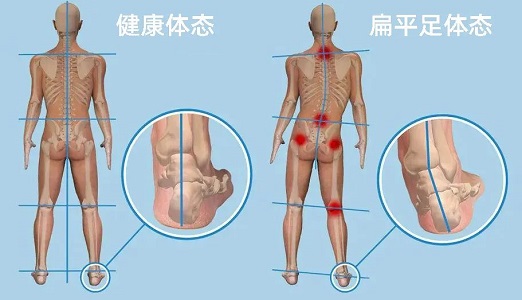 扁平足体态和健康体态对比图