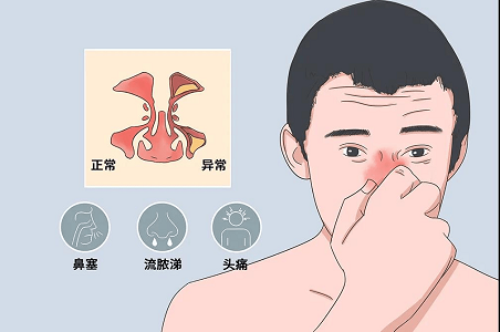 鼻渊症状图片