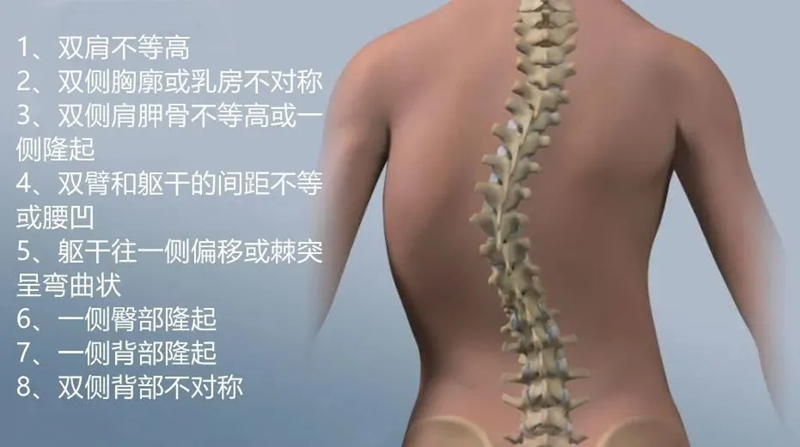 脊柱侧弯典型症状