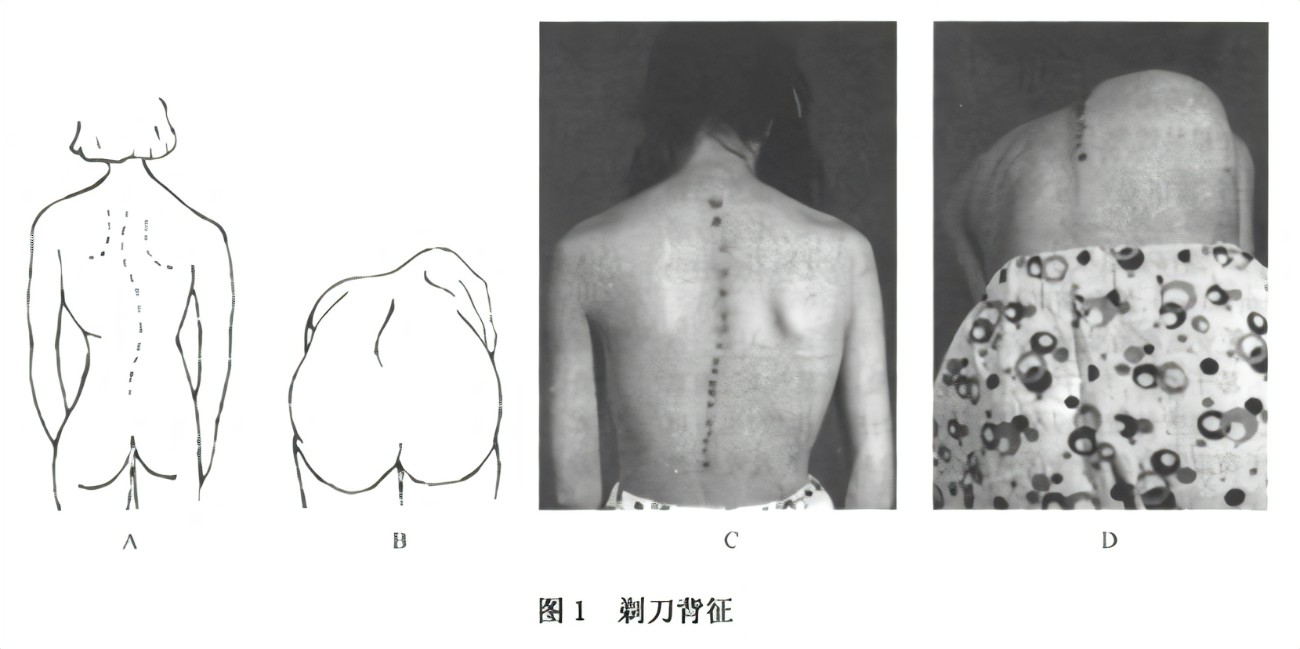 脊柱侧弯剃刀背特征