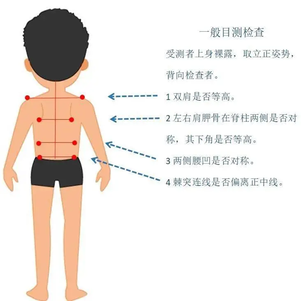 脊柱侧弯居家自测方法