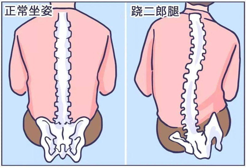 跷二郎腿和正常坐姿脊柱骨盆形态变化对比图
