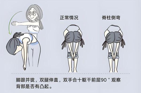 脊柱侧弯自查方法