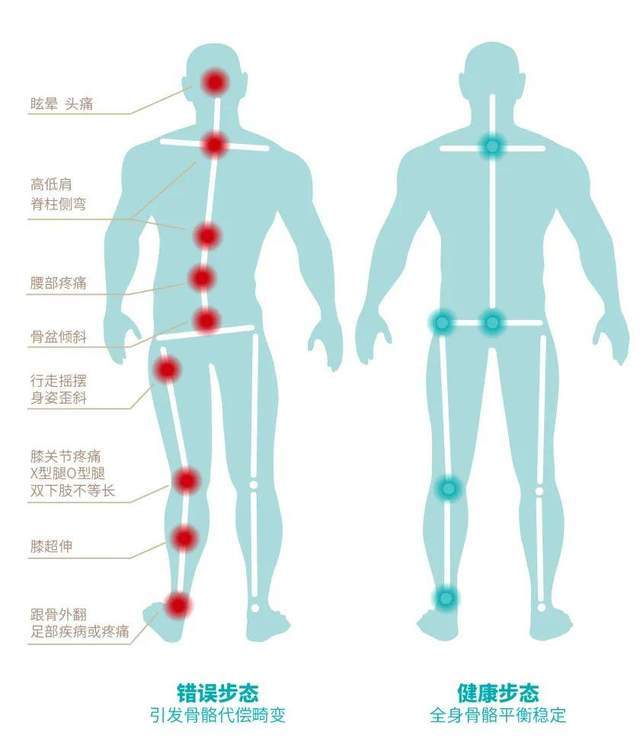 错误步态骨骼代偿畸变