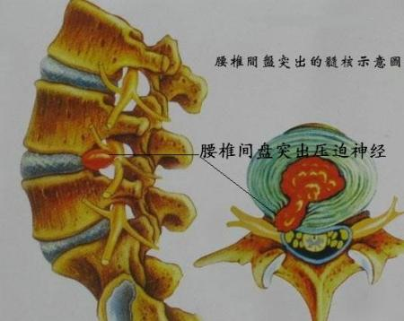 髓核压迫神经