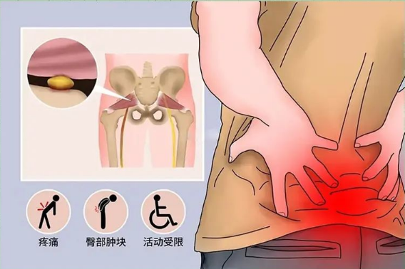 梨状肌综合征