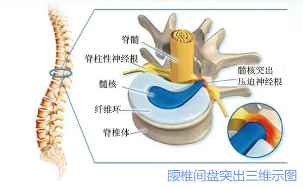 腰椎间盘突出三维示图