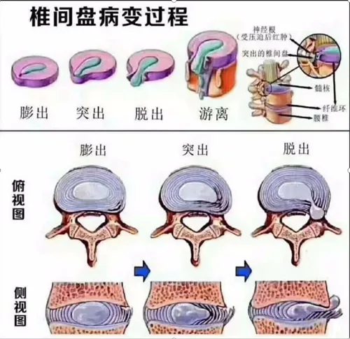 椎间盘病变过程